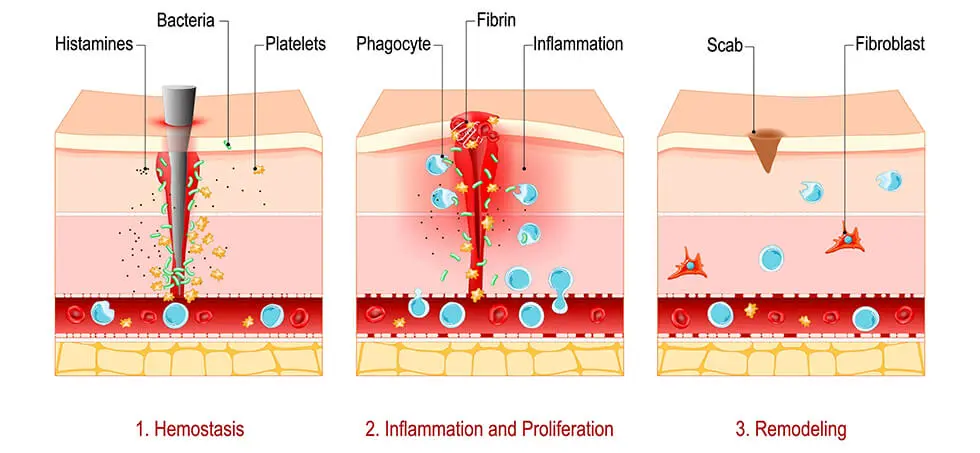 Hemostasis, Inflammatory and Proliferative, and Remodeling phase