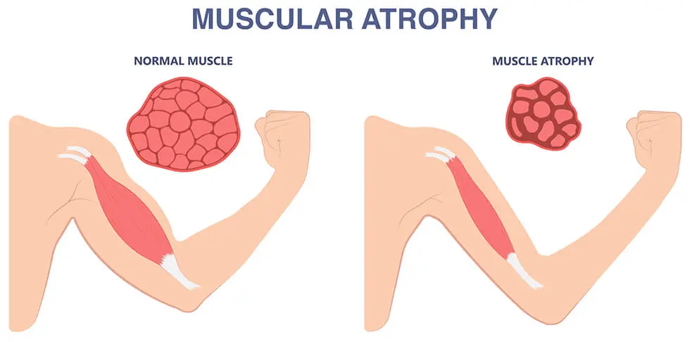Comparison between a normal muscle and an atrophied muscle